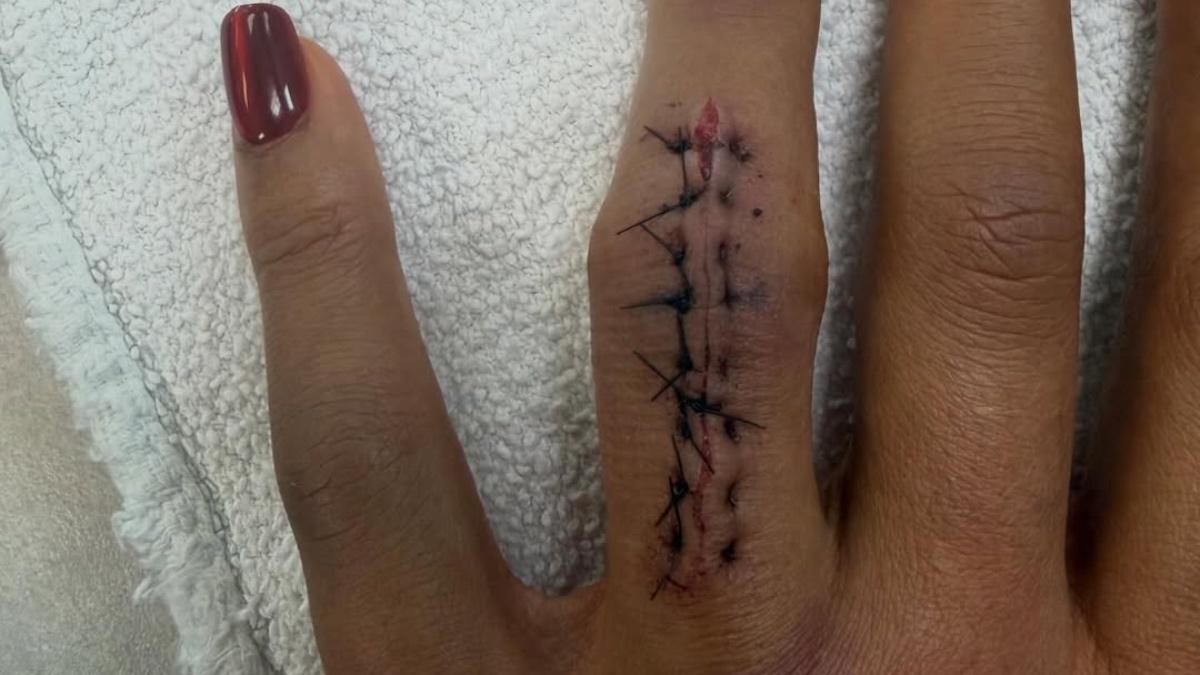 Bianca Belair's stitched-up finger