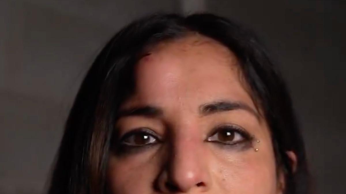 Raquel Rodriguez with a goose egg on her forehead